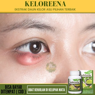 Jual Obat Benjolan Di Kelopak Mata Atas/Bawah, Mata Bengkak Bintitan ...