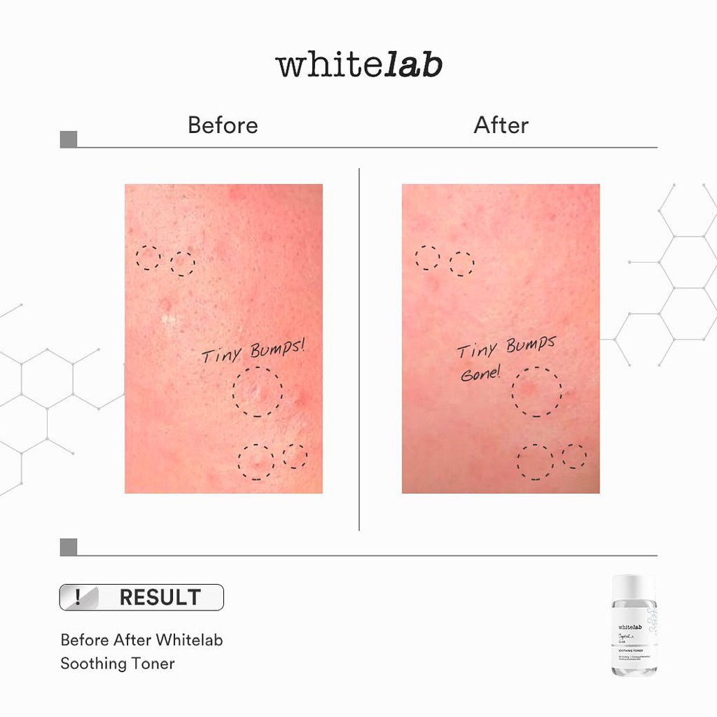 *RM* READY! WHITELAB SOOTHING TONER/ ACNE TONER BPOM