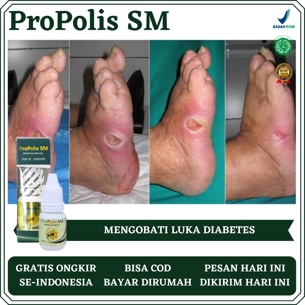 Obat Luka Diabetes, Obat Pengering Luka Diabetes, Obat Luka Diabetes Melitus, Obat Luka Diabetes Bas