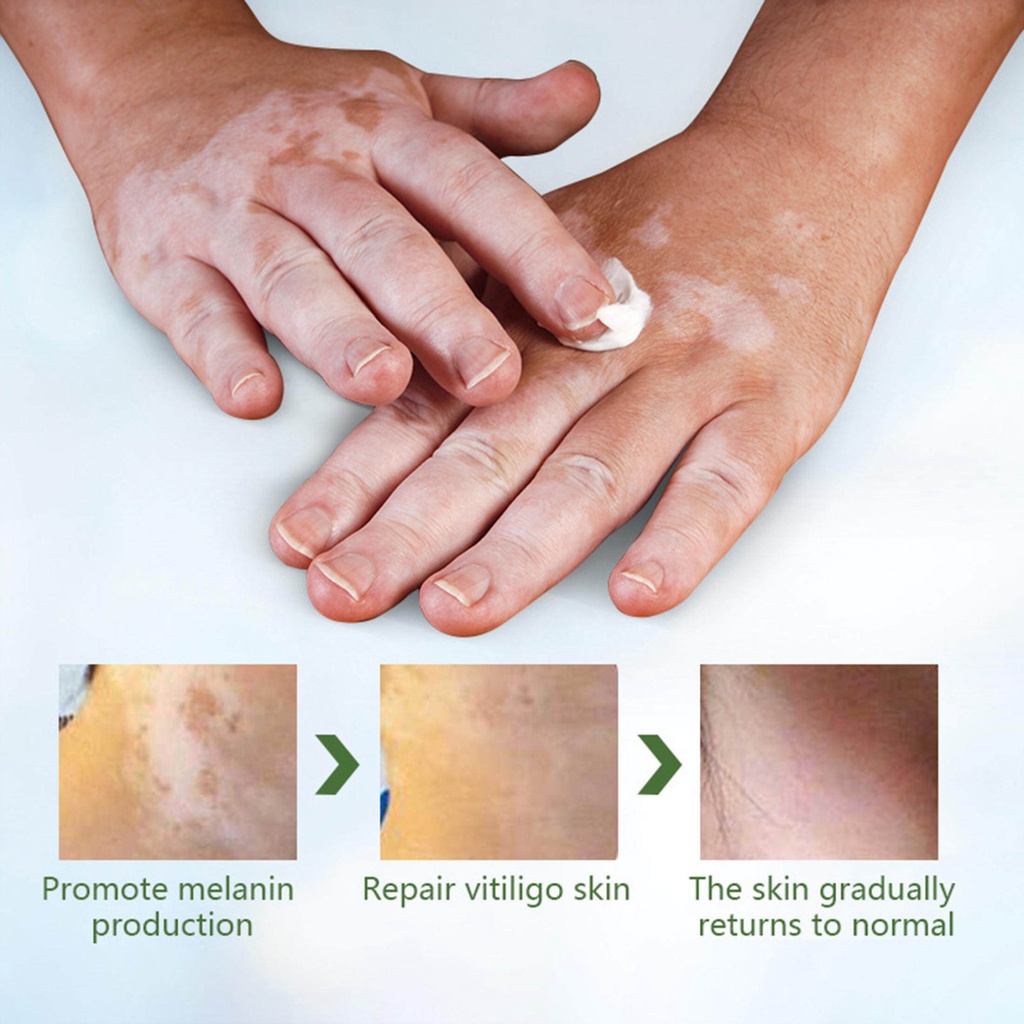 [100% Asli] Obat Penghilang Vitiligo Salep Krim Vitiligo Kulit Bercak Belang Bintik Putih Paling Ampuh 20 gr