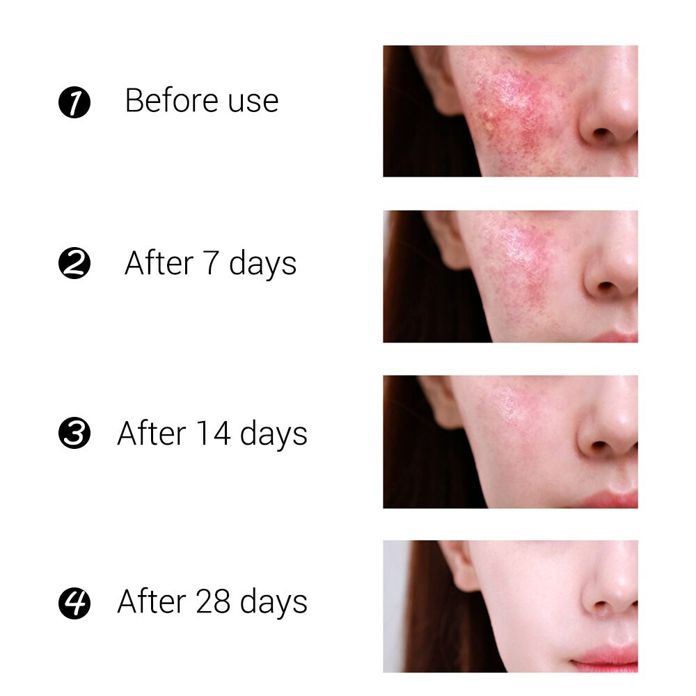 Allphv Acnes Treatment Set - Serum Acne &amp; Acne patch &amp; Masker VC Pemutih Restoratif