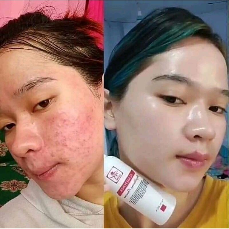 RK Glow Acne // RK Glow Premium
