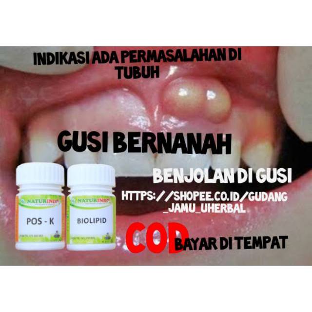 Obat Herbal Sakit Gigi Gusi Bengkak Gusi Bernanah Shopee Indonesia