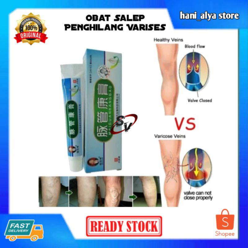 Cream Salep Varises Herbal Varicose Veins Treatment Penghilang Varises