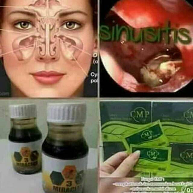 Mengobati polip atau sinusitis