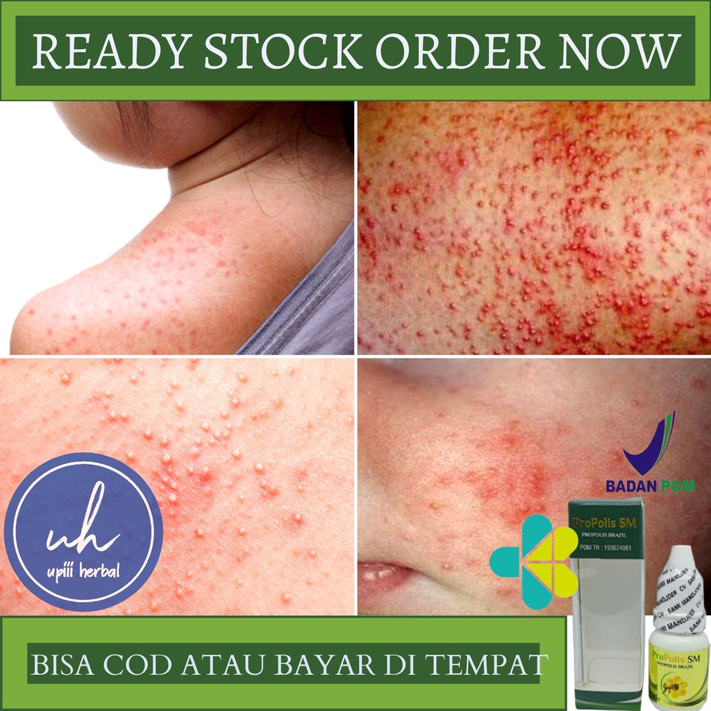 OBAT BIANG KERINGAT, OBAT HERBAL UNTUK BIANG KERINGAT, OBAT BIANG KERINGAT PADA ANAK & DEWASA, OBAT 