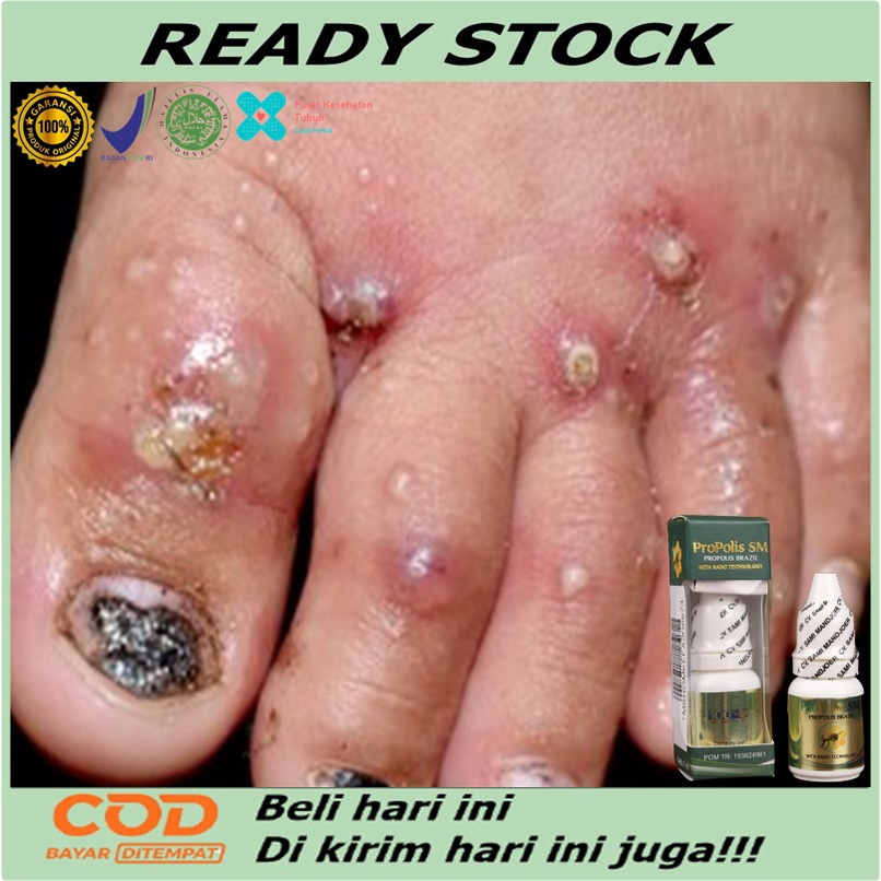 Obat budug santri, Obat buduk, Penghilang bekas budug, Borok di kaki, Obat korengan di kaki, Obat pe