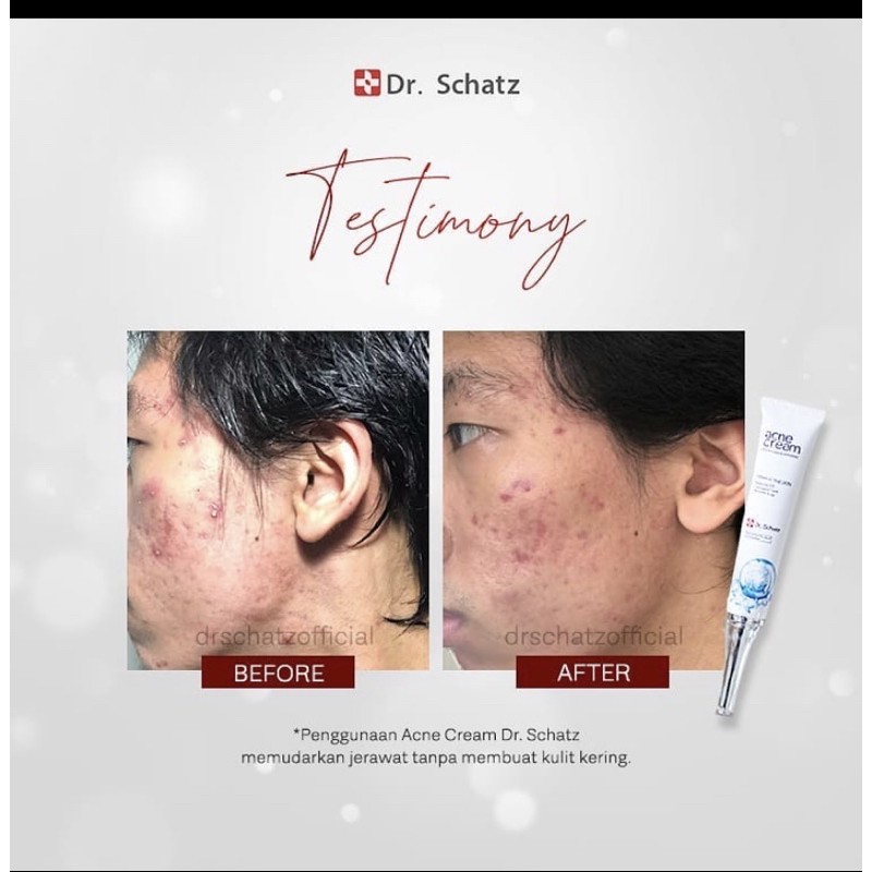 DR SCHATZ ACNE CREAM / OBAT JERAWAT