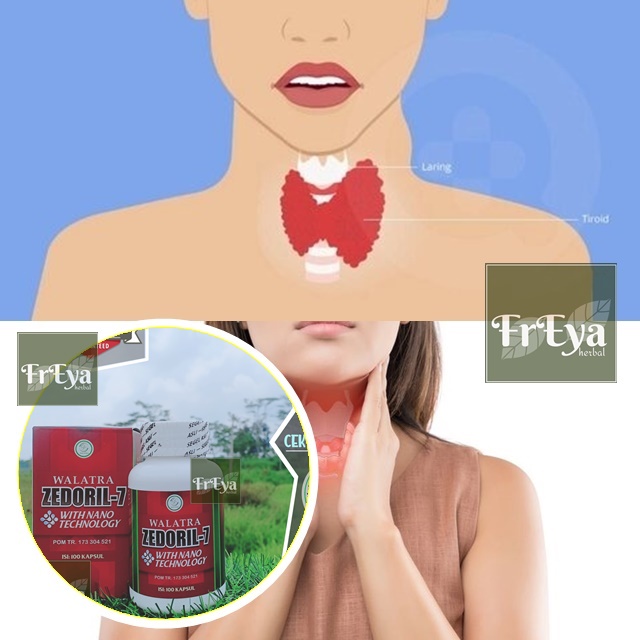OBAT KELENJAR TIROID, OBAT HERBAL GONDOK, OBAT PEMBENGKAKAN KELENJAR TIROID (BISA COD)