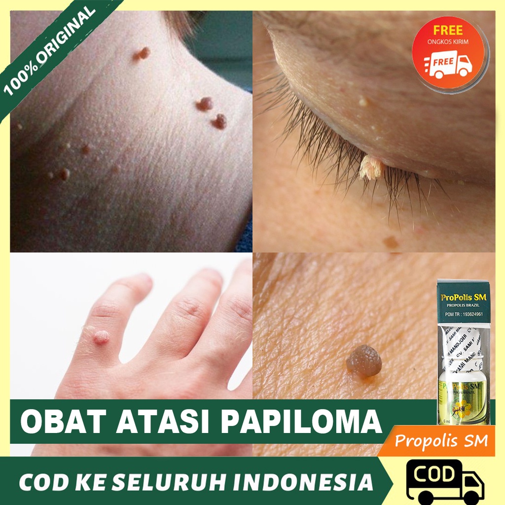 Obat Papiloma - Penghilang Papiloma - Papiloma di Leher dan Wajah - Penghilang Kutil - Kutil di Waja