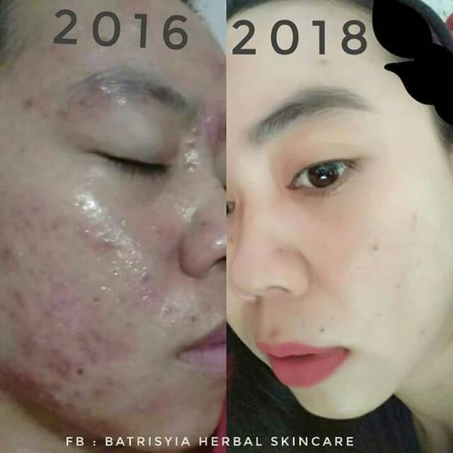 Serum acne