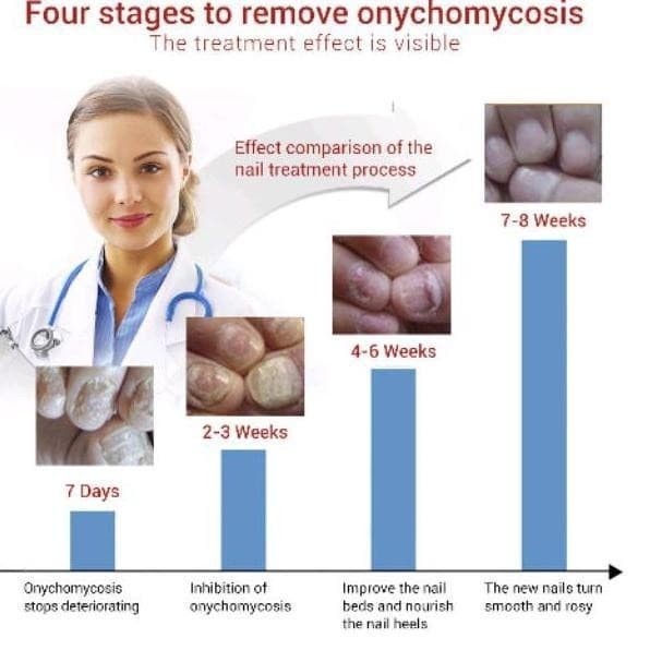 Obat Kuku Jari Kaki Berjamur Jamur Onychomycosis Paronychia