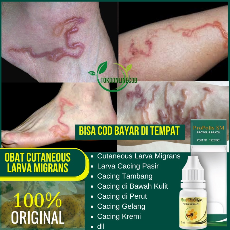 Jual Obat Cutaneous Larva Migrans Infeksi Cacing Kulit Larva Cacing 8353