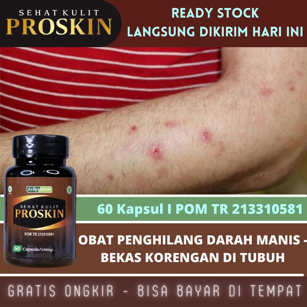 Obat Menghilangkan Bekas Luka Hitam Menahun, Obat Koreng Di Kaki, Obat Bekas Korengan, Obat Darah Manis, Obat Gatal Gatal Merah, Obat Bekas Gigitan Nyamuk, Obat Budug Bernanah, Obat Budug, Obat Budug Santri, Obat Penghilang Bekas Luka Dengan Proskin