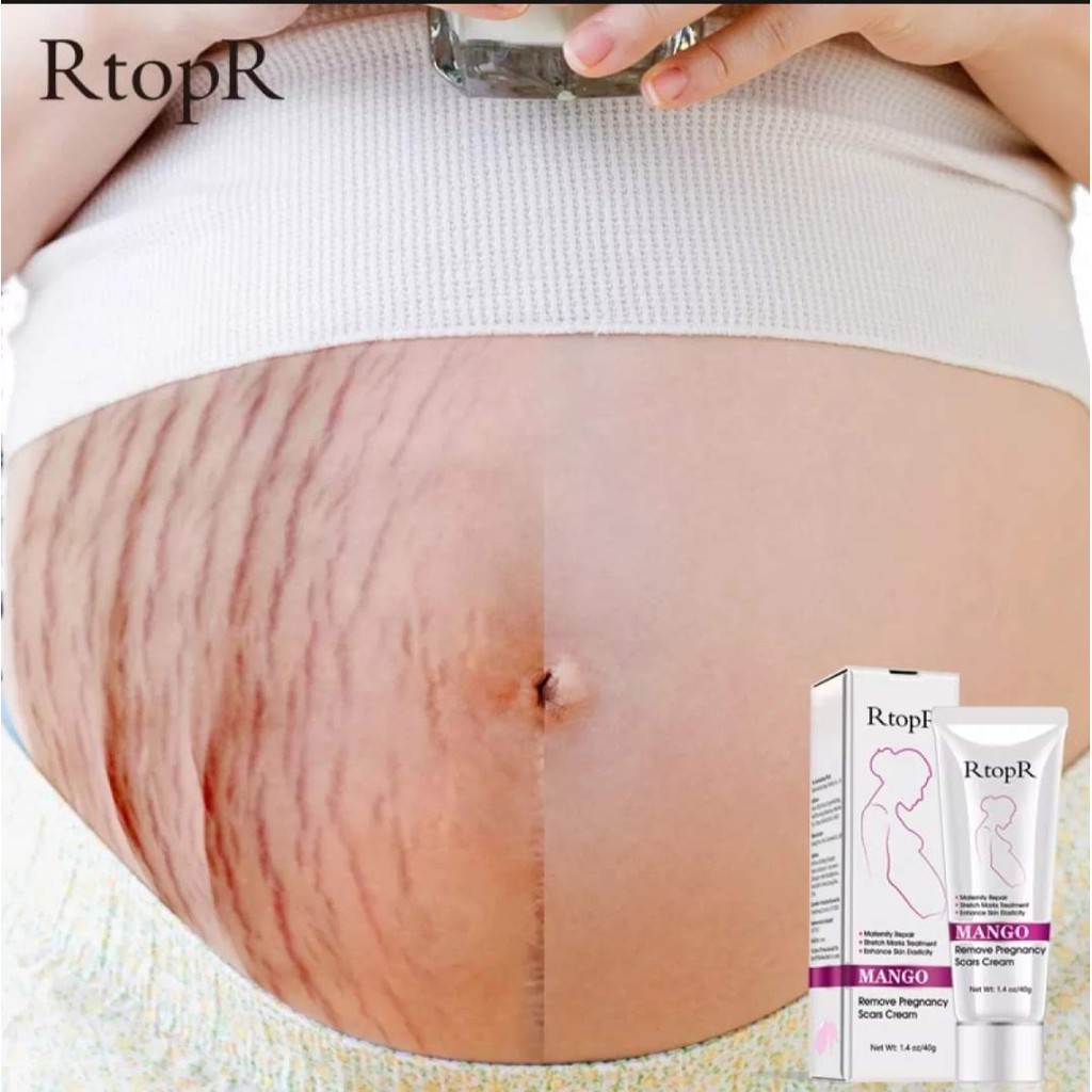 Rtopr Stretch Mark Cream  - Penghilang Strech Mark / Bekas Luka Ampuh Oermanen bpom Krim Stretch Mark