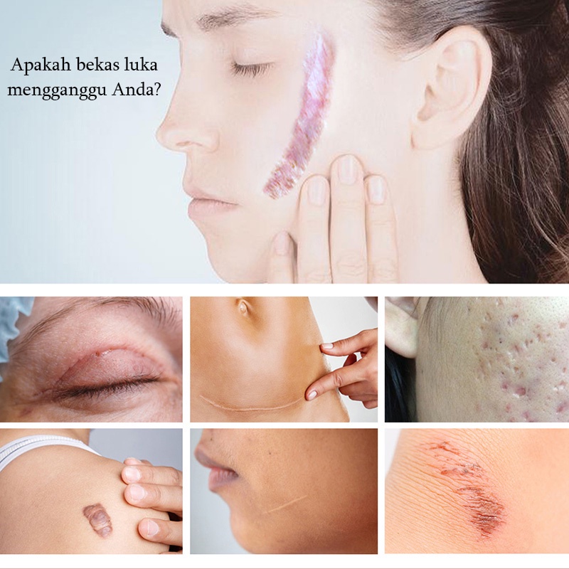 Krim Cream Salep penghilang luka bekas Menghilangkan stretch mark Penghilang bekas luka yang ampuh Memperbaiki bekas luka bakar Bekas Jerawat Bekas luka lama Benjolan dan jerawat 50G