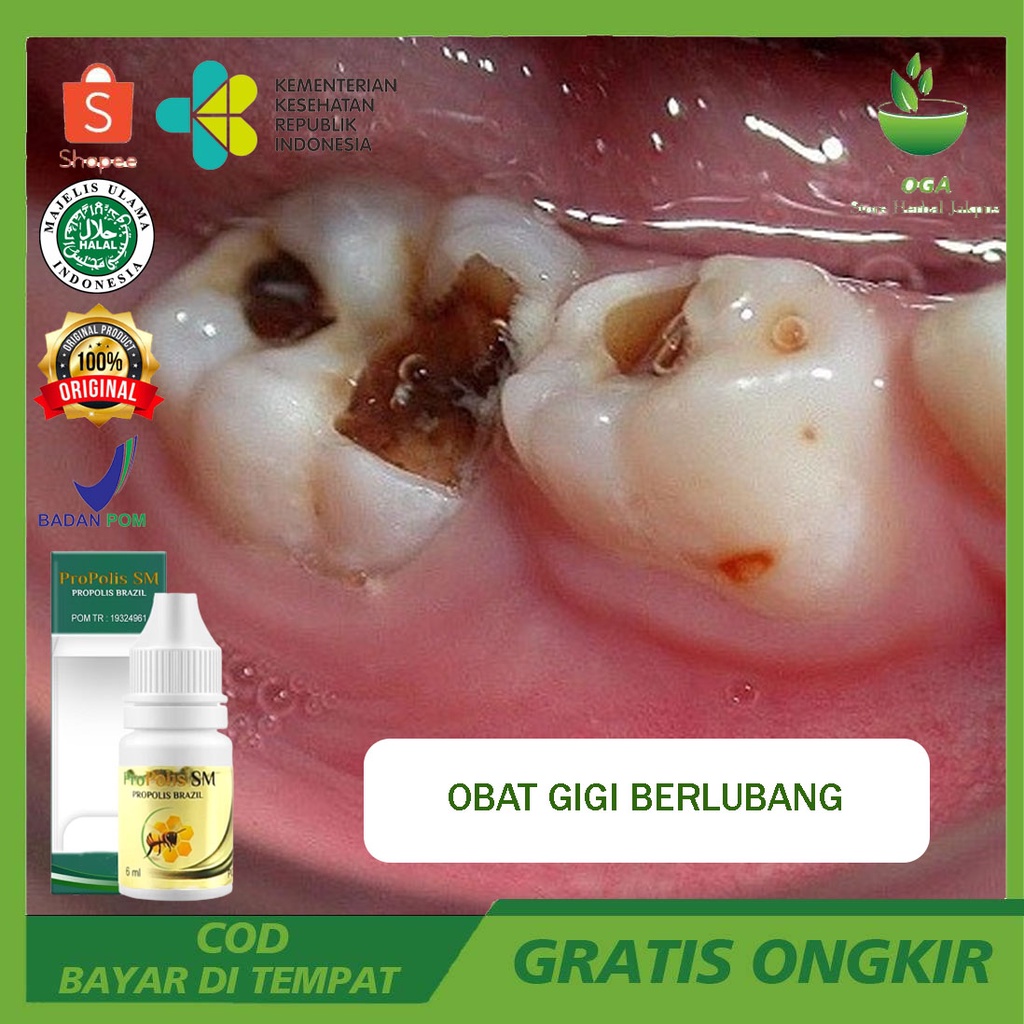 Obat Gigi Berlubang Agar Copot, Gigi Ngilu Dan Berlubang, Gigi Kuning Jadi Putih, Gigi Keropos Berlu