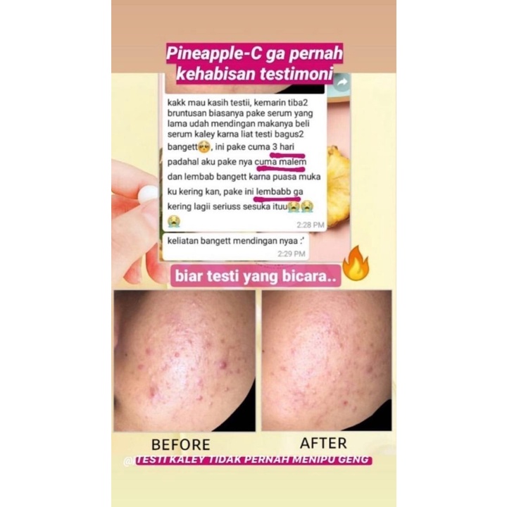 (New FORMULA)ORI!! KALEY Pineapple-c Lightening Essence Serum Nanas vitamin c acne perawatan wajah-5