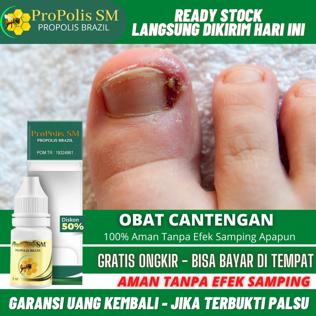 Obat Cantengan, Obat Tetes Kuku Cantengan, Cantengan Jempol Kaki, Kuku Jempol Cantengan, Cantengan T