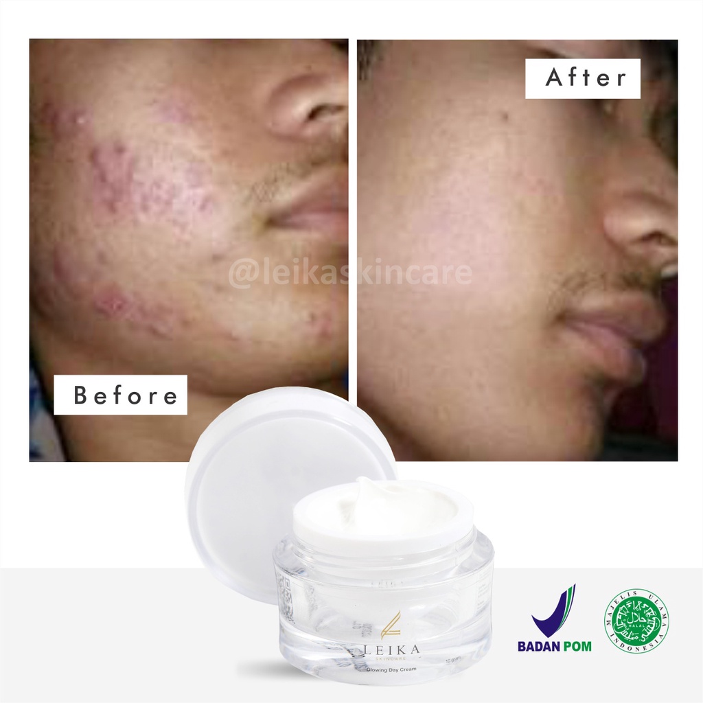 Cream Penghilang Jerawat Ampuh Sudah BPOM! Cream Penghilang Jerawat Membandel Krim Penghilang Jerawat Penghilang Bekas Jerawat Obat Jerawat &amp; Bekas Jerawat Cream Penghilang Bekas Jerawat Glowing Day Cream Leika Skincare 10gr Halal MUI Resmi BPOM