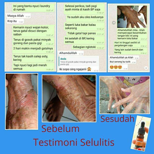 british propolis untuk psoriasis)