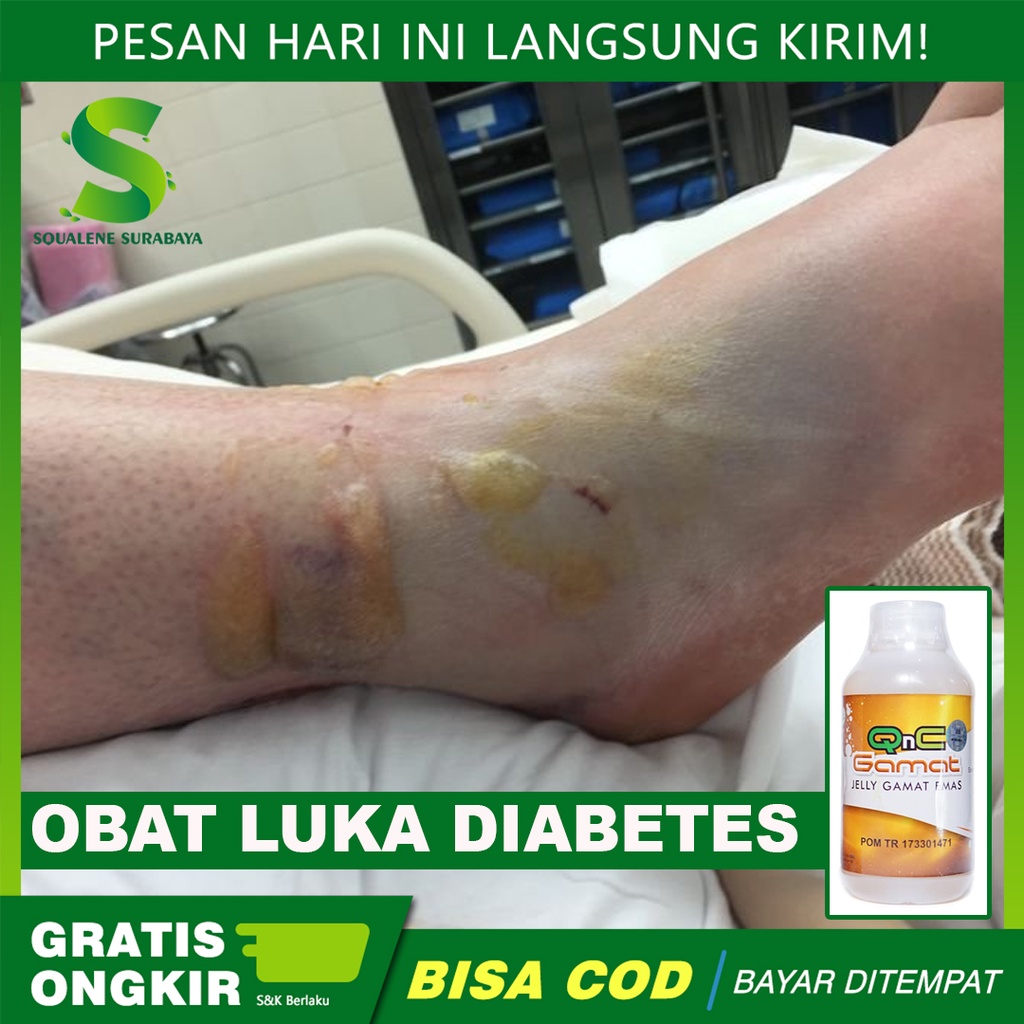 Obat Luka Diabetes Gangren - Pengering Luka Diabetes - Luka Diabtes Basah - Obat Luka Diabtes Agar K
