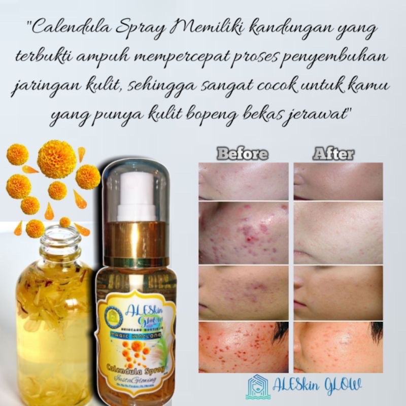 Perawatan Wajah Glowing  CALENDULA FACE MIST Jerawat Flek Hitam Skincare Korea Serum Paket Kecantikan