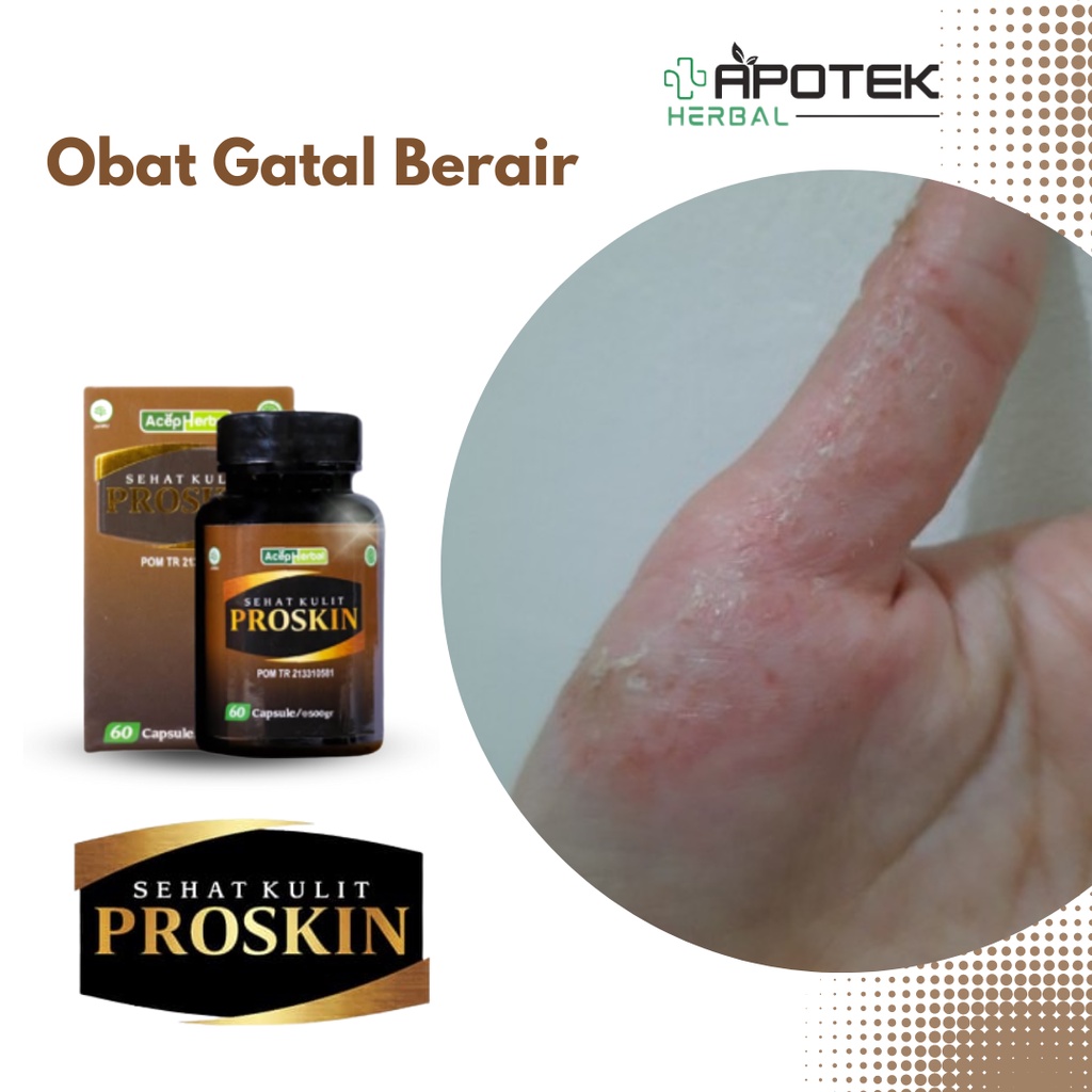 Obat Gatal Berair, Jari Tangan & Kaki Gatal Berair, Obat Bintik Bening Berair, Gatal Kutu Air, Cacar