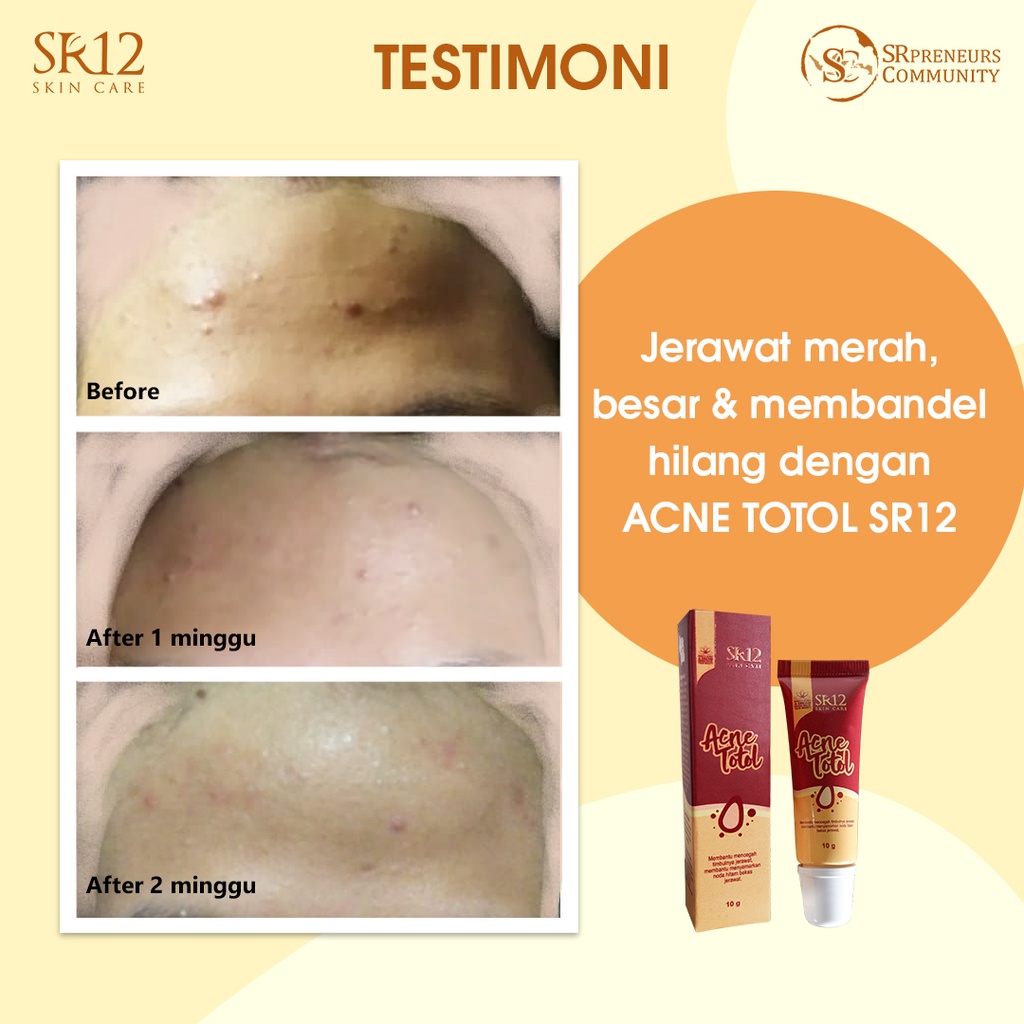 PAKET PENGHILANG JERAWAT SR12 / ACNE SERIES SR12 / ATASI JERAWAT SECARA AMPUH / MENCERAHKAN &amp; MEREGENERASI KULIT WAJAH / PAKET LENGKAP PENGHILANG JERAWAT SR12 / PAKET PENGHILANG BOPENG &amp; BEKAS JERAWAT / PAKET MENYEMBUHKAN JERAWAT / PAKET LENGKAP SR 12