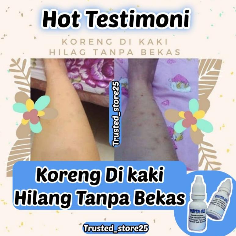 [KODE PRODUK IMFWQ7542] (BISA COD) CHITA OIL PENGHILANG BEKAS LUKA, KULIT KORENG, EXSIM, JERAWAT, FL