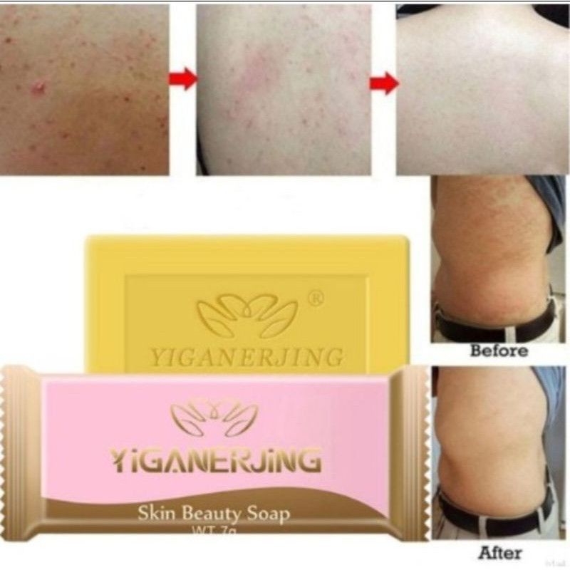 Yiganerjing Salep &amp; Sabun Obat Eksim Gatal Psoriasis Dermatitis - Salep Yiganerjing Krim Obat Herbal Gatal