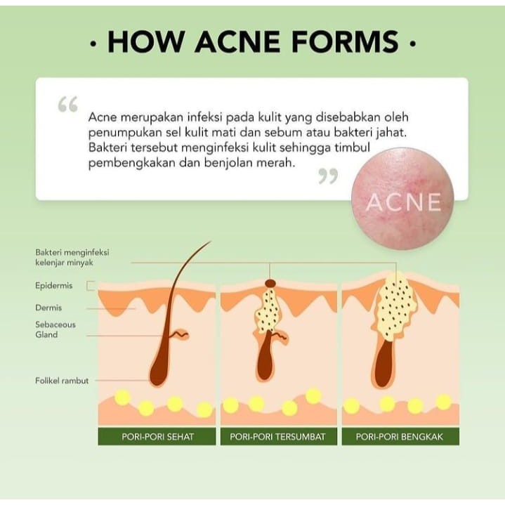 YOU AcnePlus Triple Action Spot CareX NEW SERIES 15 gr/EMPEROR/