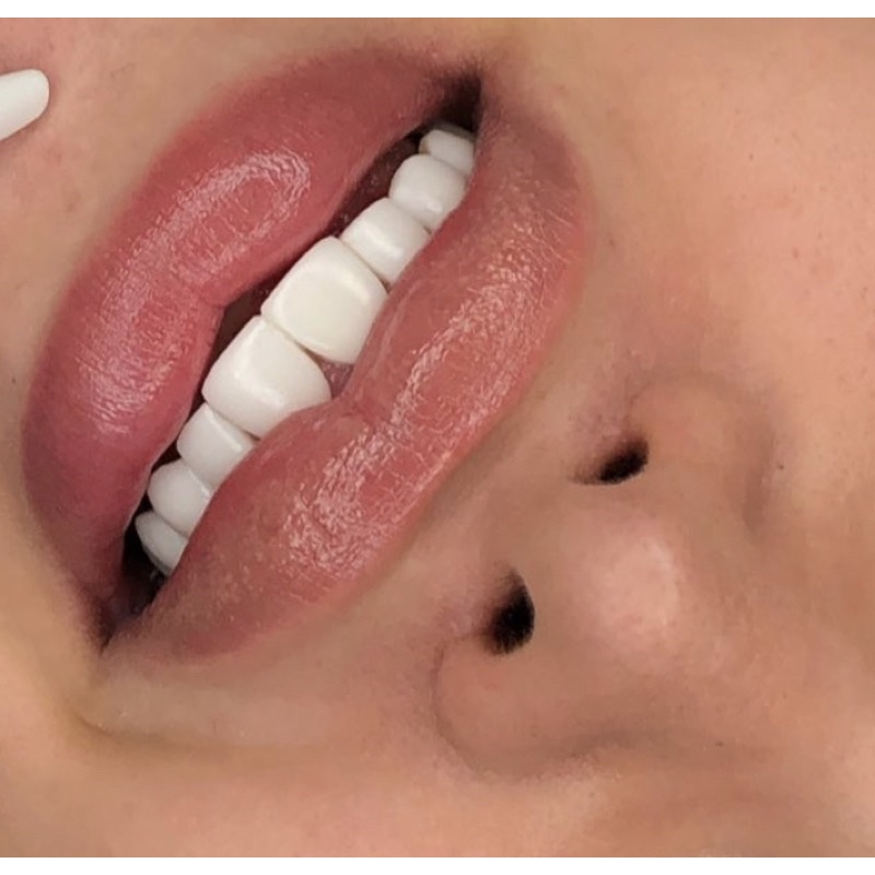 Veneer
