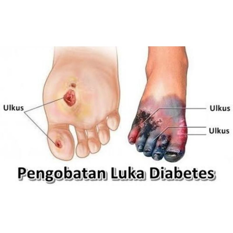 Obat Luka Diabetes (Bubuk Tabur)