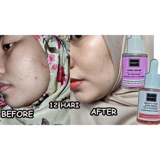 [ORI] Serum Mini Scarlett Acne Meredakan Jerawat Meradang Iritasi Kemerahan Meregenerasi Kulit I BPOM 15ml