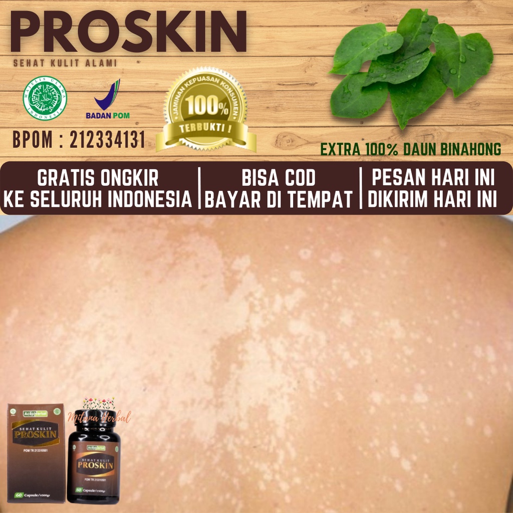 Obat Panu, Obat Panu Anak, Obat Panu Wajah, Balas Bogo, Obat Hapur, Kurap, Eksim, Scabies, Gudig/Gud