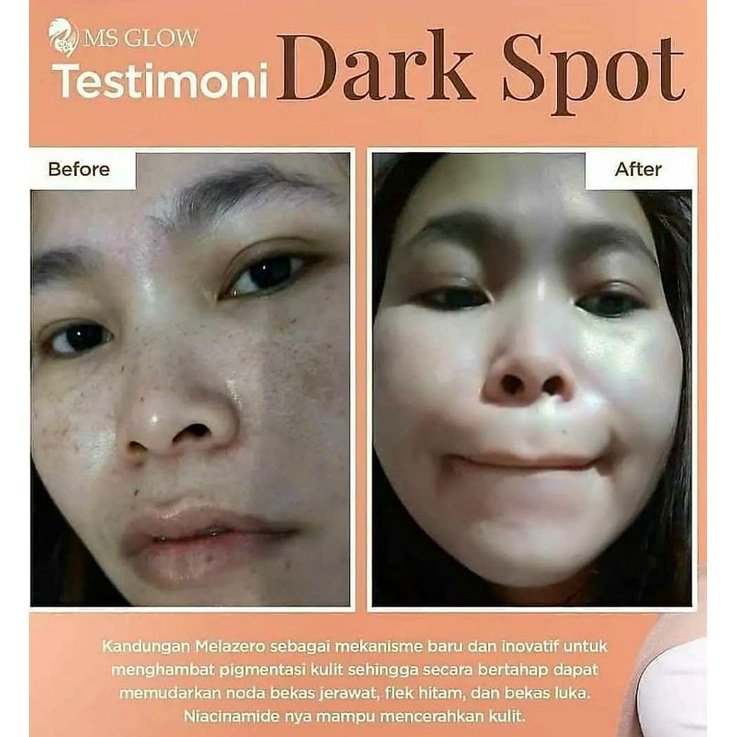 Dark Spot Treatment Serum II Khusus Flek MS GLOW