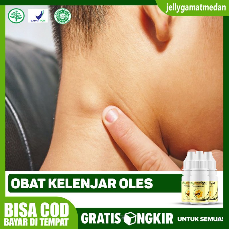 Obat Kelenjar Oles, Tiroid, Kelenjar Getah Bening, Teroid - Propolis SM Terlaris di Medan