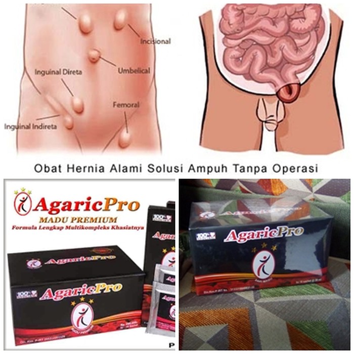 

AGARICPRO HERBAL I hernia sembuh tanpa operasi