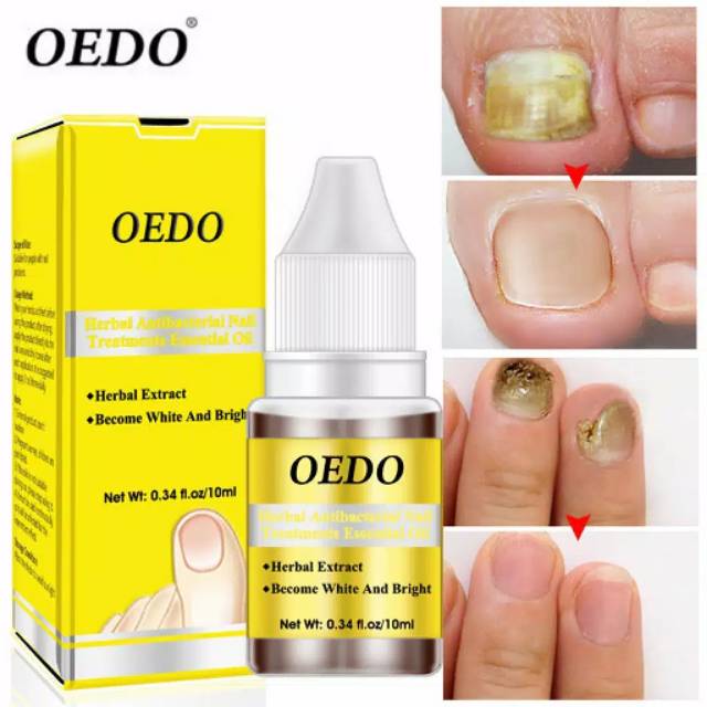 OEDO ESSENTIAL OIL perawatan jamur kuku