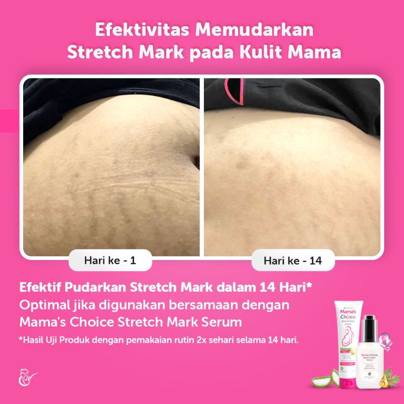 Mama's Choice Stretch Mark Cream - Untuk Perut Gatal Dan Stretch Mark