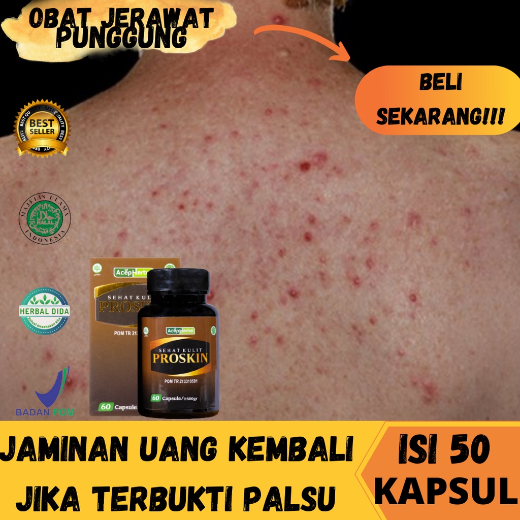 PROSKIN 100% ORIGINAL BPOM, Obat Jerawat Punggung Membandel, Obat Jerawat di Punggung Dan Bekasnya, 