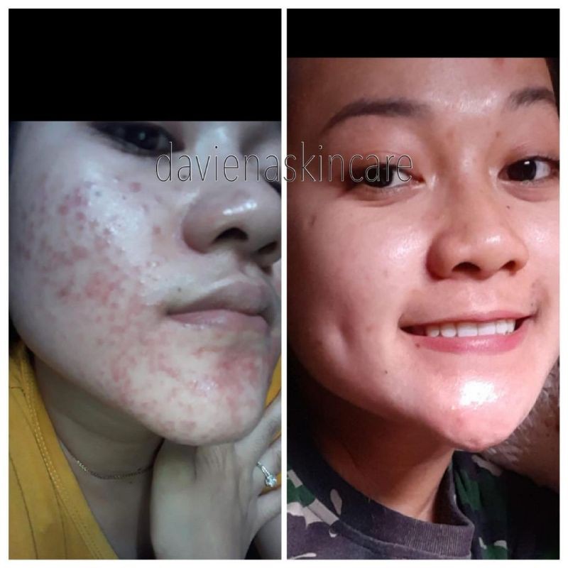 [Official] ACNE SERIES|CREAM JERAWAT AMPUH BPOM DAVIENA SKINCARE|Daviena Skincare