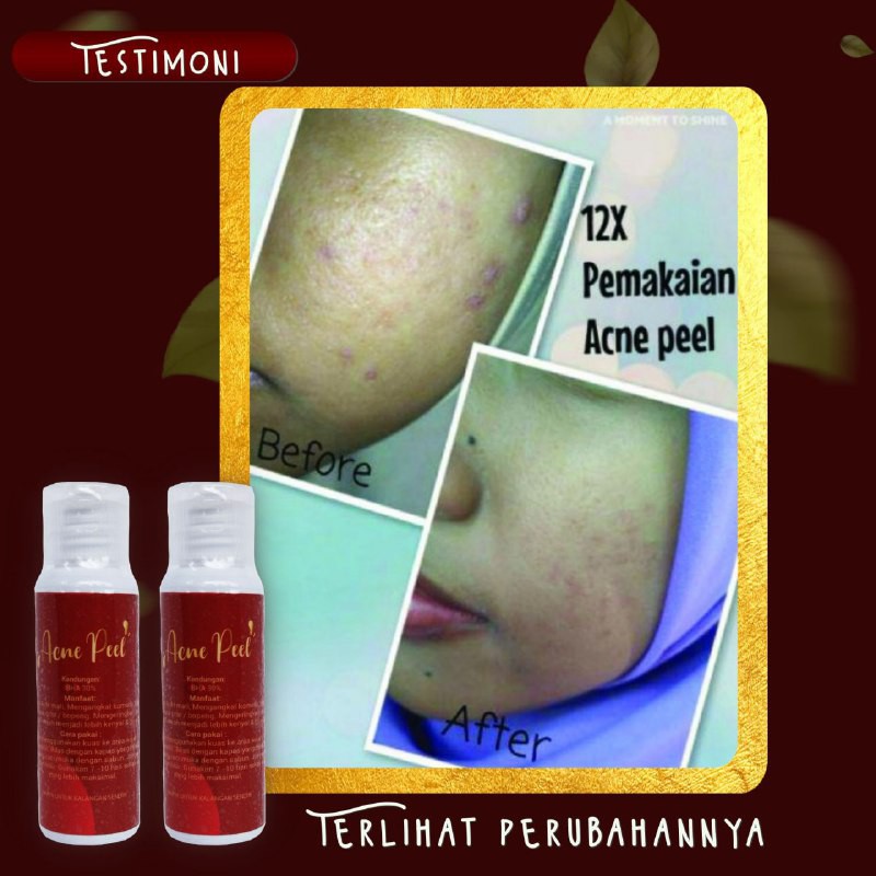 ACNE PEEL SR12 / PEELING WAJAH