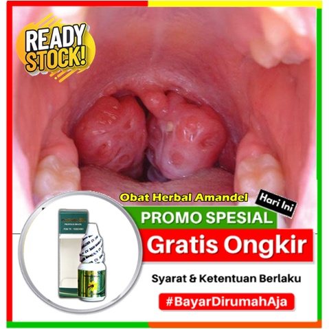 Obat Herbal Amandel Akut Parah, Pengempis/Pengempes Amandel Bengkak Dewasa & Anak, Penyembuhan Amand