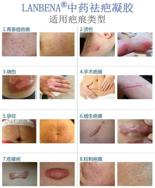 Lanbena TCM Scar and Acne Mark Removal Gel Ointment /penghilang bekas jerawat