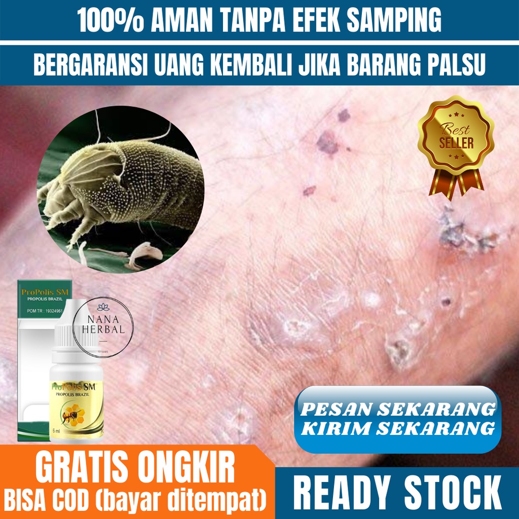 Obat Budug Dan Gatal,  Obat Budug Bernanah di Punggung, Obat Cenang Bernanah di Punggung, Obat Bisul