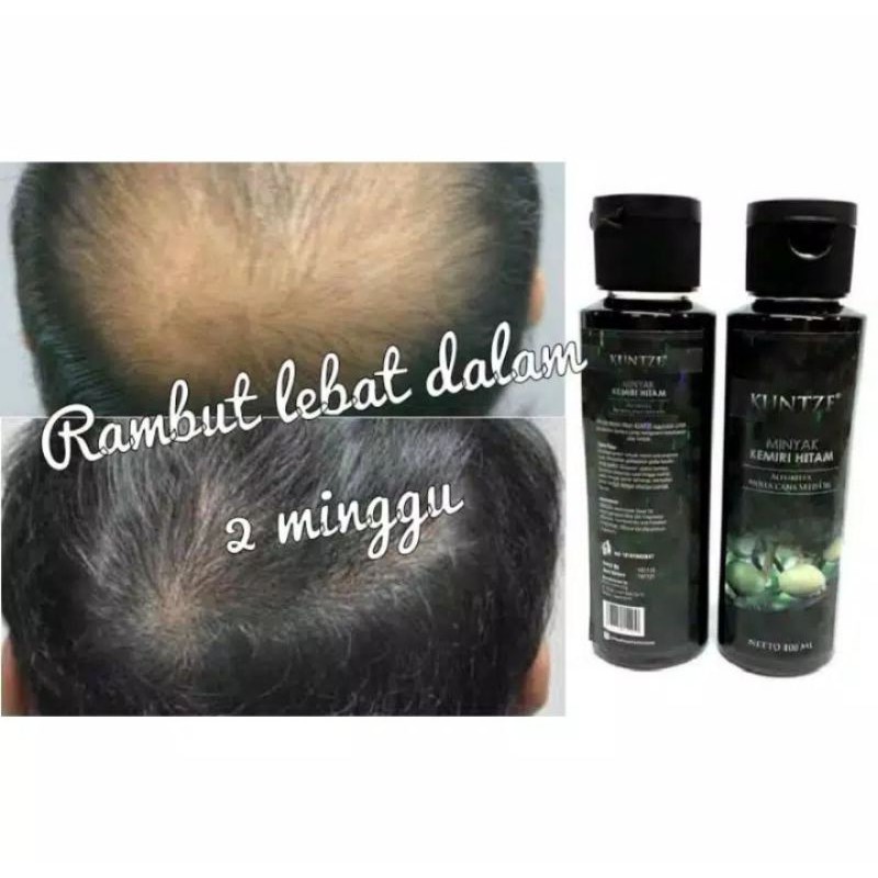 Jual Minyak Kemiri Original Penumbuh Rambut Subur Vitamin Rambut Obat Botak Penumbuh Rambut Bayi Indonesia Shopee Indonesia