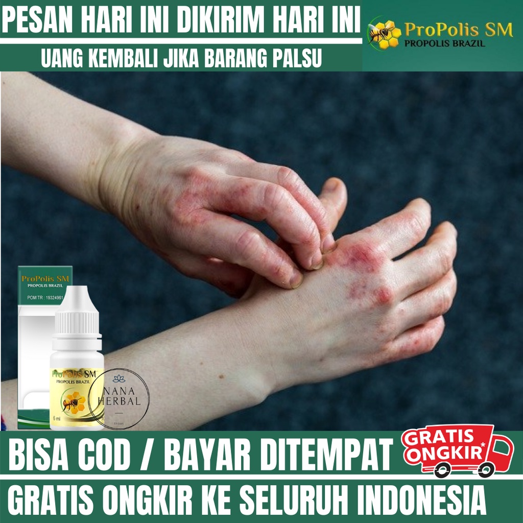 Obat Kulit Gatal Iritasi, Obat Iritasi Kulit Wajah, Obat Iritasi Kulit, Obat Oles Kulit Perih karena
