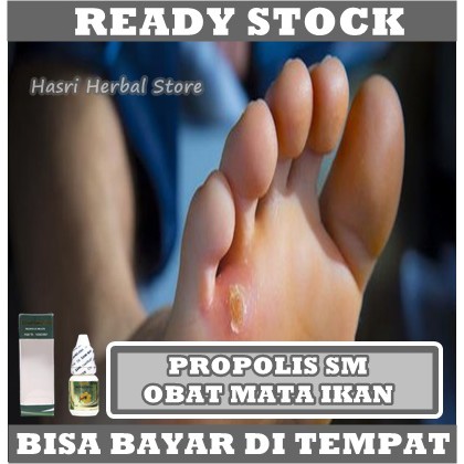 Obat Mata Ikan - Obat Bobotoleun Alami, Benjolan Keras Di Jari dan Telapak Kaki, Obat Kapalan, Clavus / Klavus, Benjolan Keras Kecil Di Samping Kaki, Infeksi Tonjolan Keras Bisa Sembuh Dengan Propolis SM Untuk Plester Mata Ikan Lunak